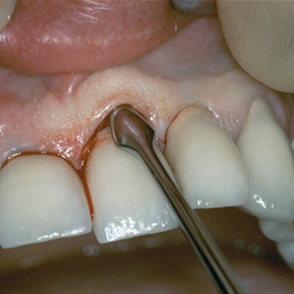 GDC Periosteal Elevator Buser - 6 (PPBUSER)