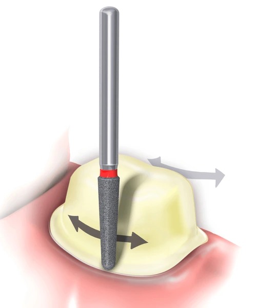 Frank Dental Tapered Round Diamond Bur TR Series (Fine)