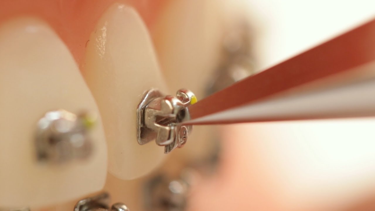 Pwortho Active & Passive Self-Ligating Brackets