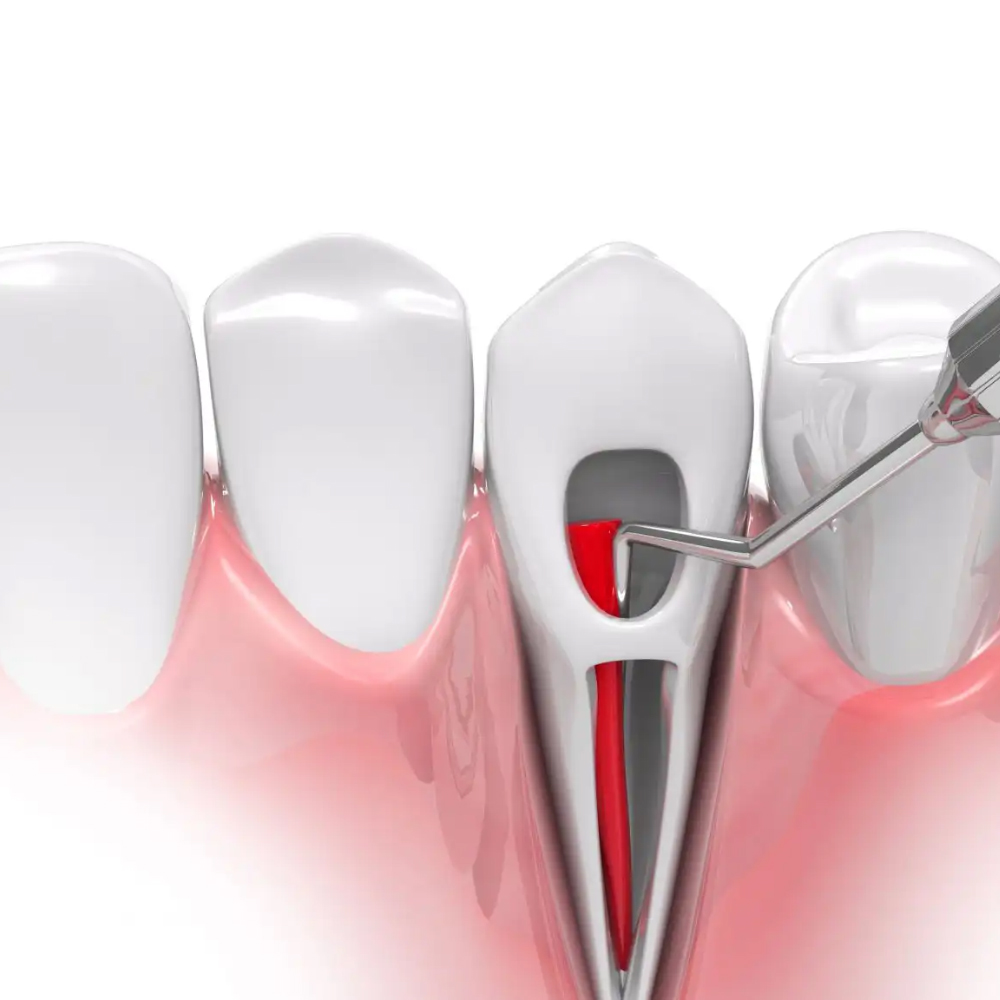 GDC Root Canal Plugger - (.50mm) RCP50 #3