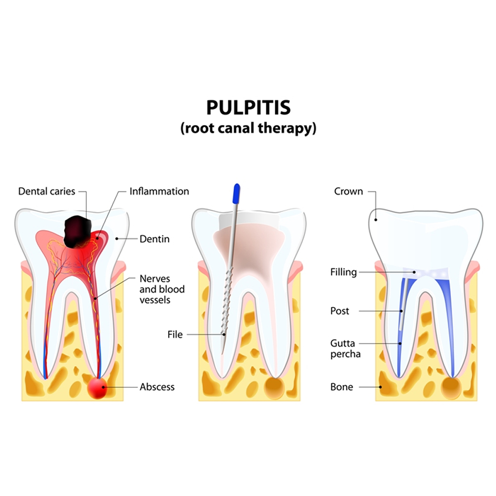 Waldent Reamers 21mm (Pack of 6)