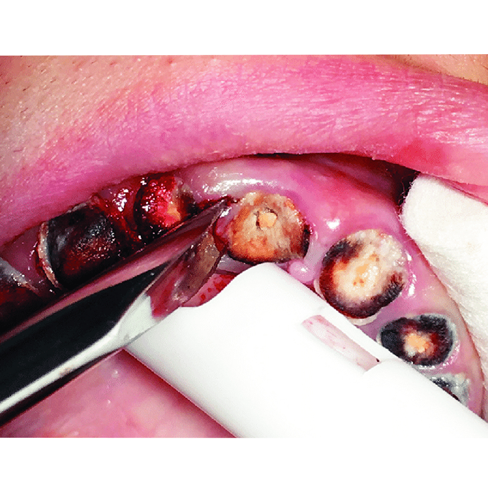 GDC Root Elevators Set Of 9 In Pouch Premium (Repp9)