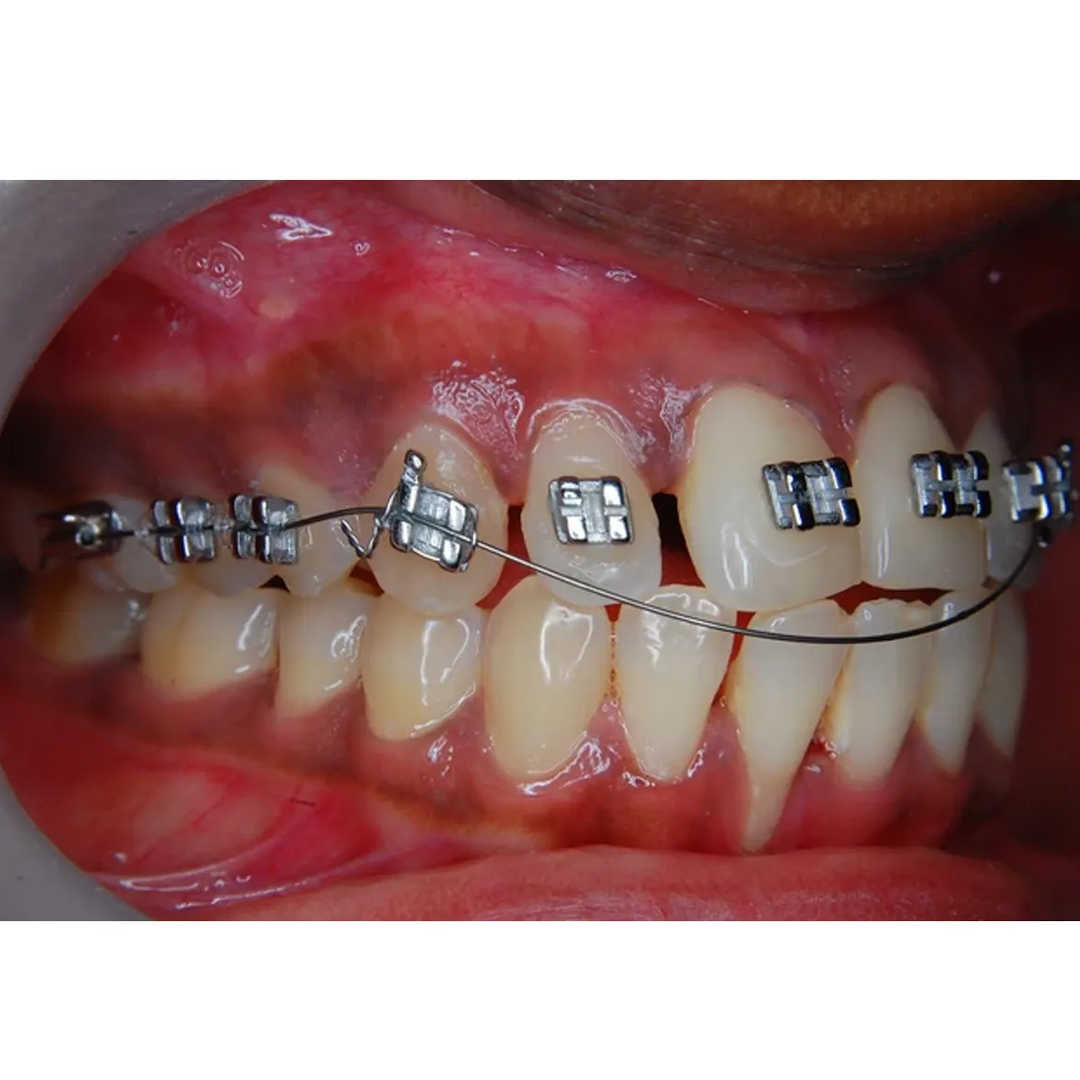 OSL NiTi Reverse Curve Archwires - Rectangular (Pack Of 10)