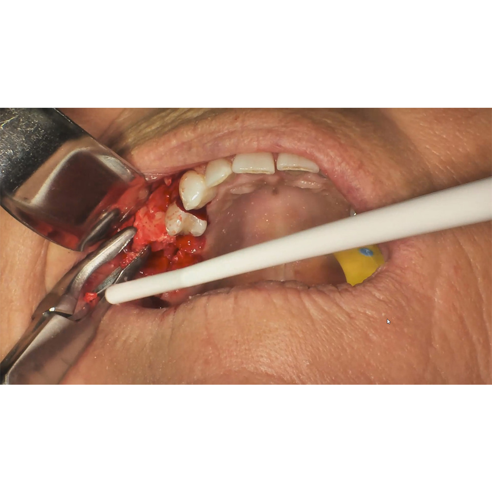 Oracraft Bone Rougeurs