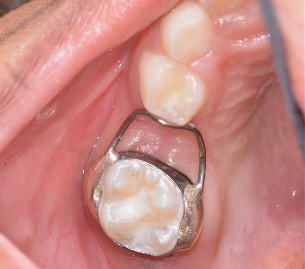 Kids-e-Dental Curved Loops (Pk of 10)