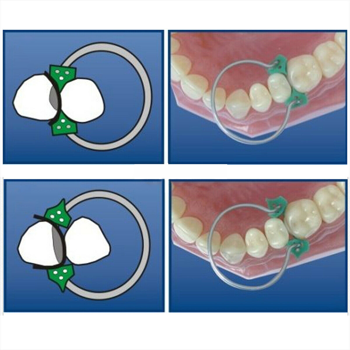 ET Dental Silicone Wedges