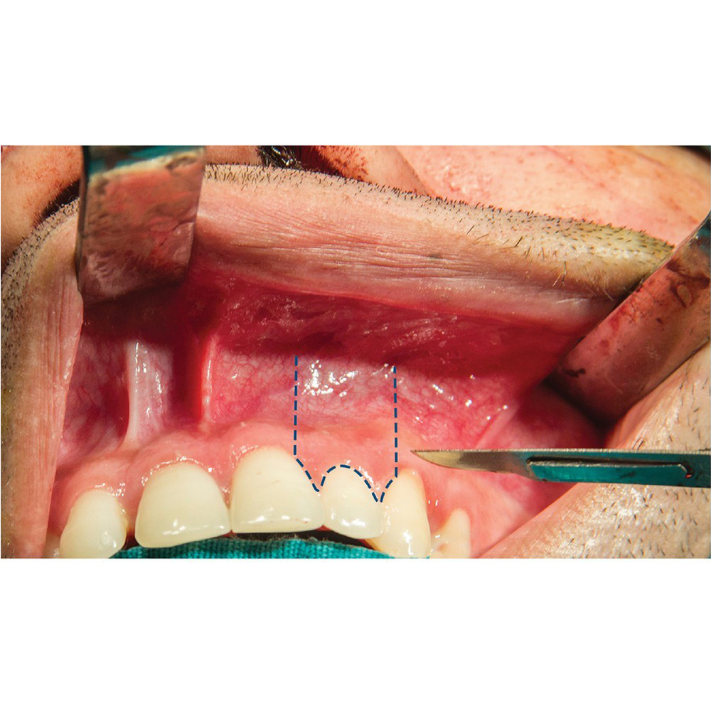 GDC Scalpel Solid Curved Handle 14.5cm (10-130-5AE)