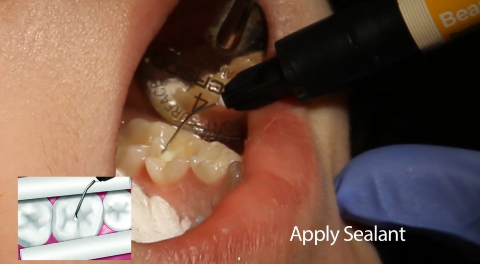 Shofu BeautiSealant Pit & Fissure Sealant