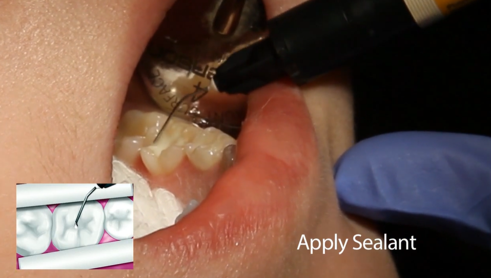 Shofu BeautiSealant Pit & Fissure Sealant