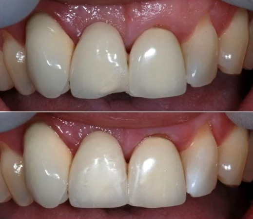 Shofu P & R Repair Kit