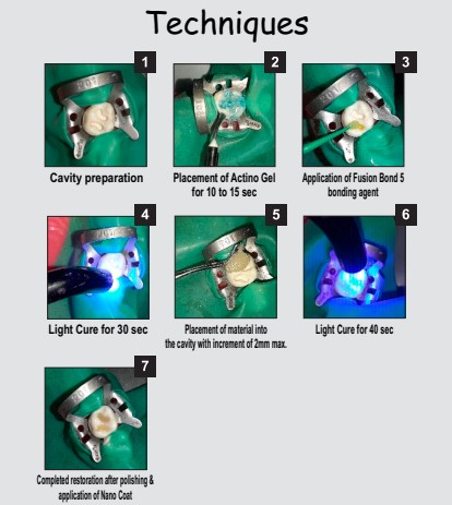 Prevest Denpro Fusion Universal Composite Intro Kit