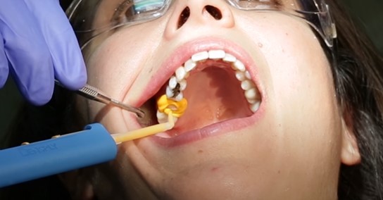 ET Dental Intra Oral Tips