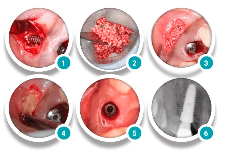 Novabone Porous Granules 1 x 0.5cc (0.25gm)