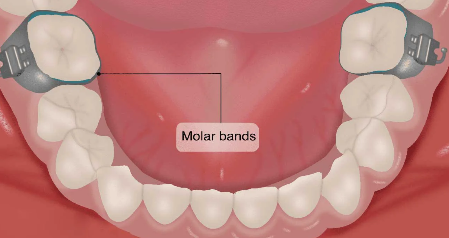 U Ortho Molar Bands Non-Convertible Mbt 0.022 2nd Molar (Pack of 4)
