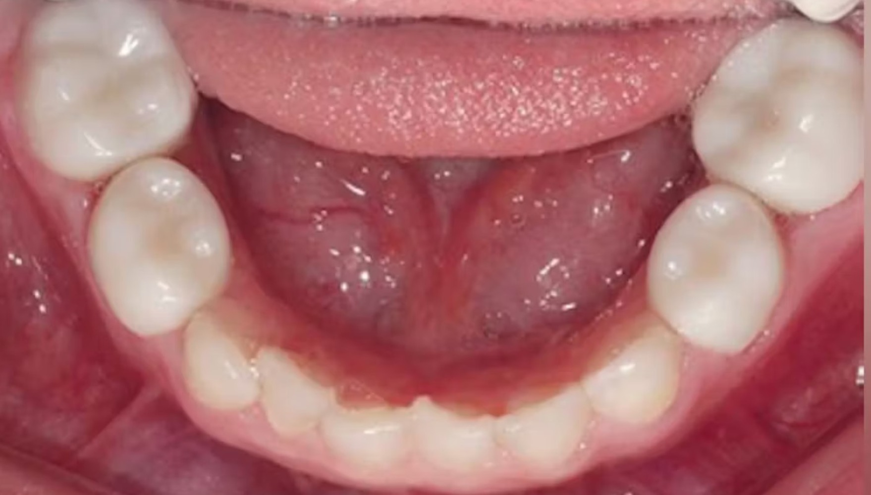 Kids-e-Crown Zirconia Lower Right 1st Molar Refills