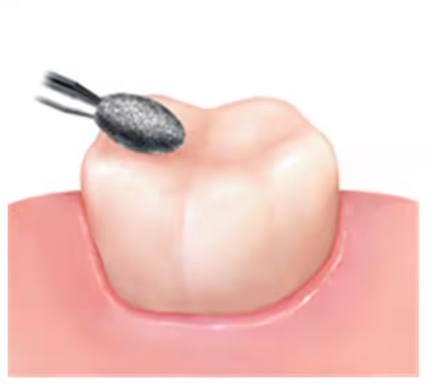 NewDiamond Flame Ogival Diamond Bur -FO (Pack Of 3)