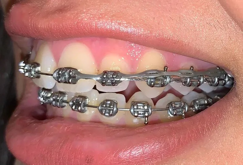 U Ortho E-Chain (15 ft) - Continuous Grey