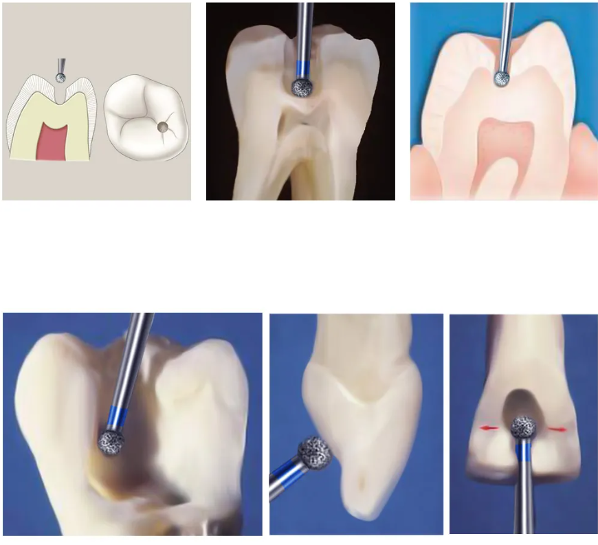 NewDiamond Ball Collar Diamond Bur -BC (Pack Of 3)