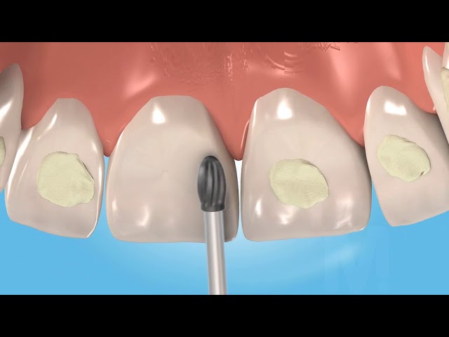 Prima Dental Orthodontic Debonding Bur (safe end)