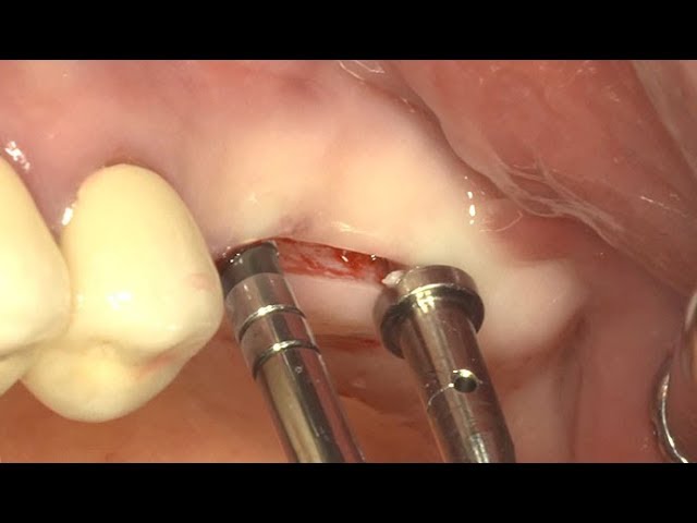 Api+ Osteotomes convex set of 12 (KOC12)