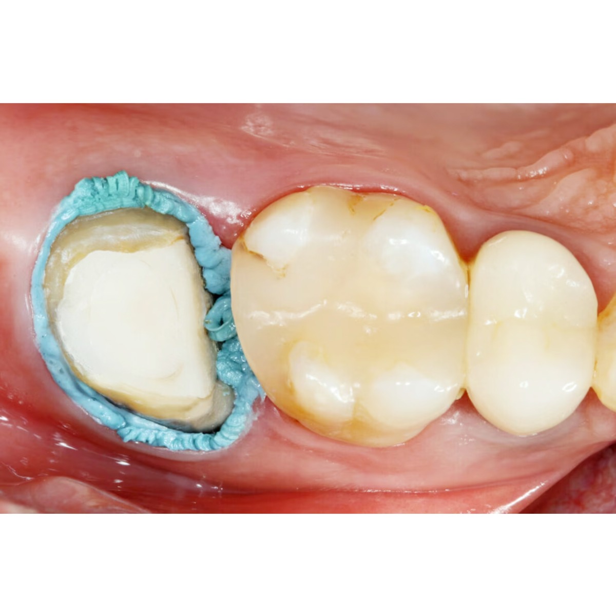 3M ESPE Astringent Retraction Material - Paste