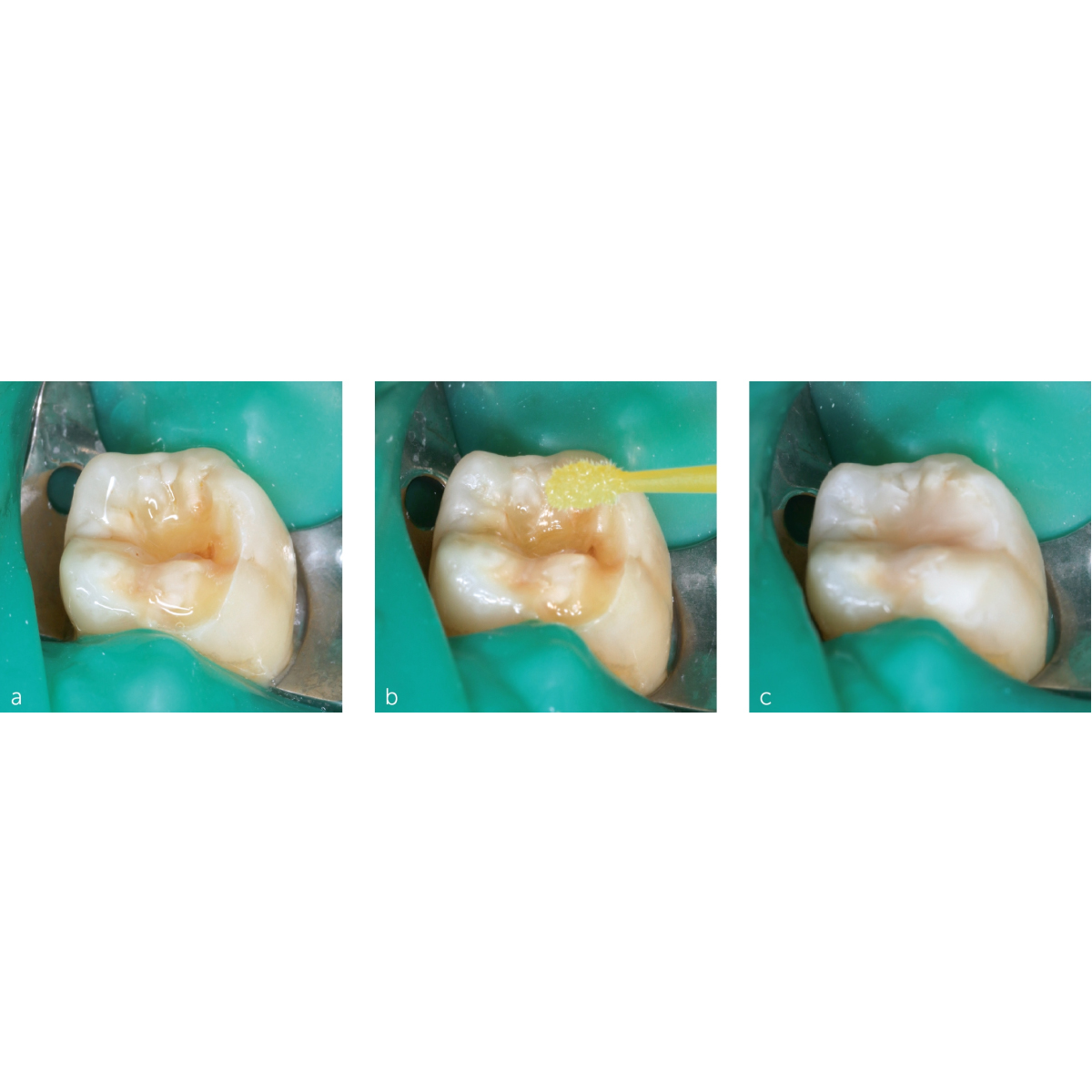 Prime Dental Restorite Cavo Surface Sealer