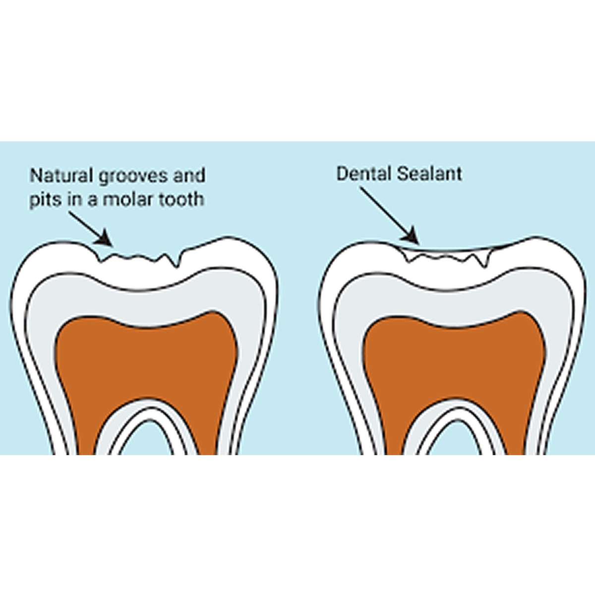 Prime Dental Restorite Cavo Surface Sealer