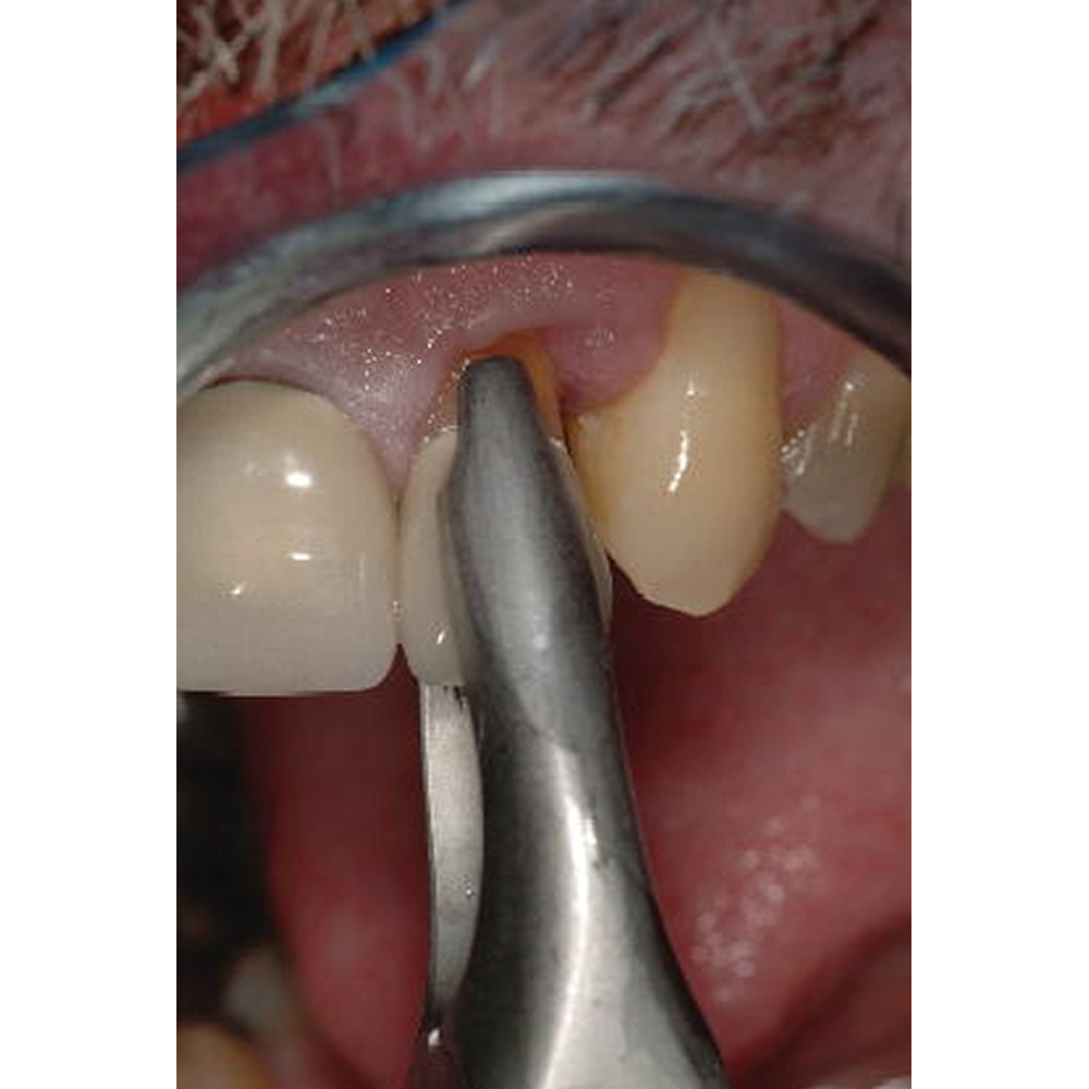 GDC Extraction Forceps Secure