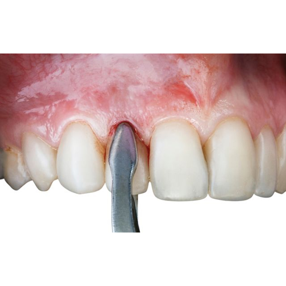 GDC Extraction Forceps Upper Roots - 951.00 Secure (Sfx951.00)