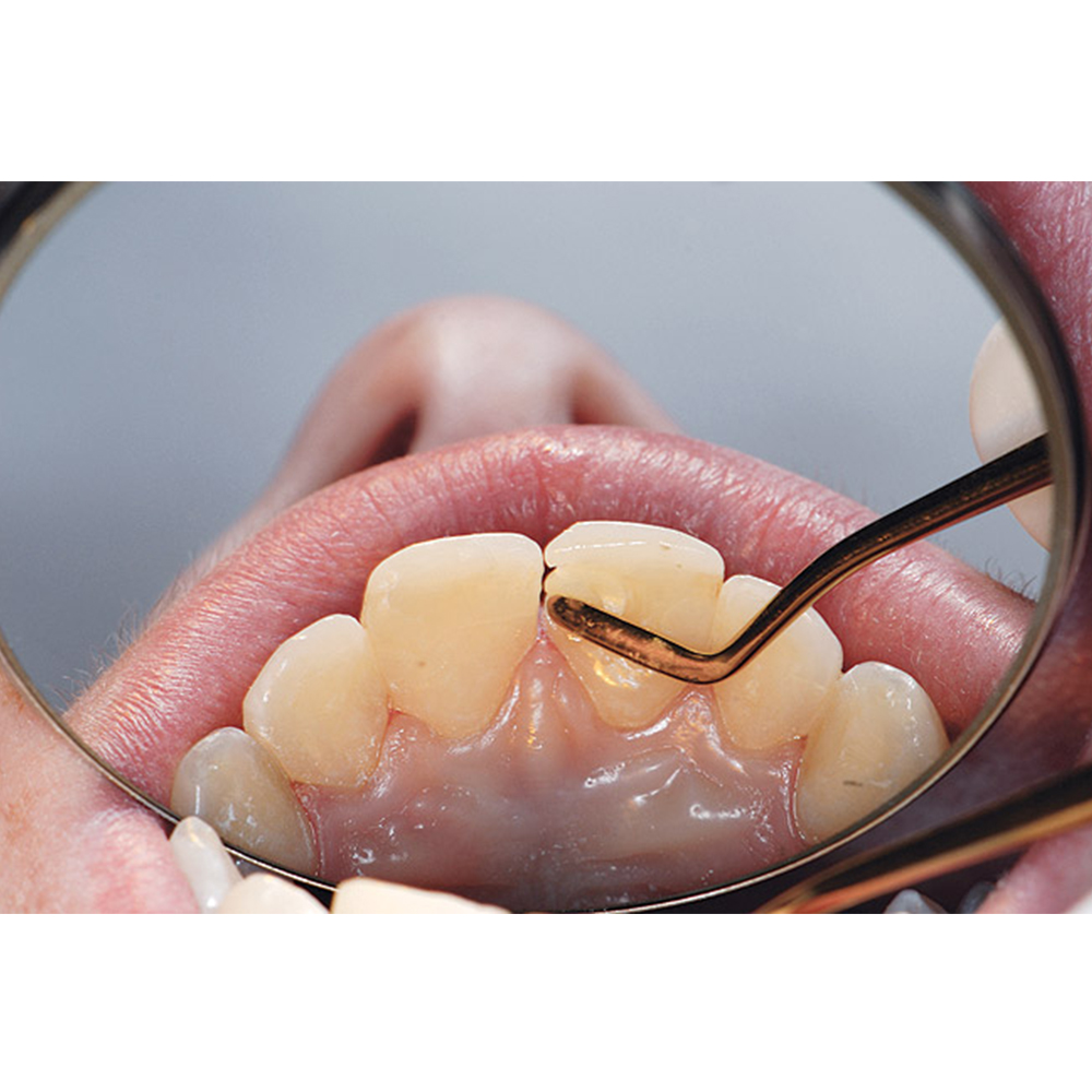 GDC Composite Instrument Flexi Thin Gold Titanium -6 (CIGFT2)