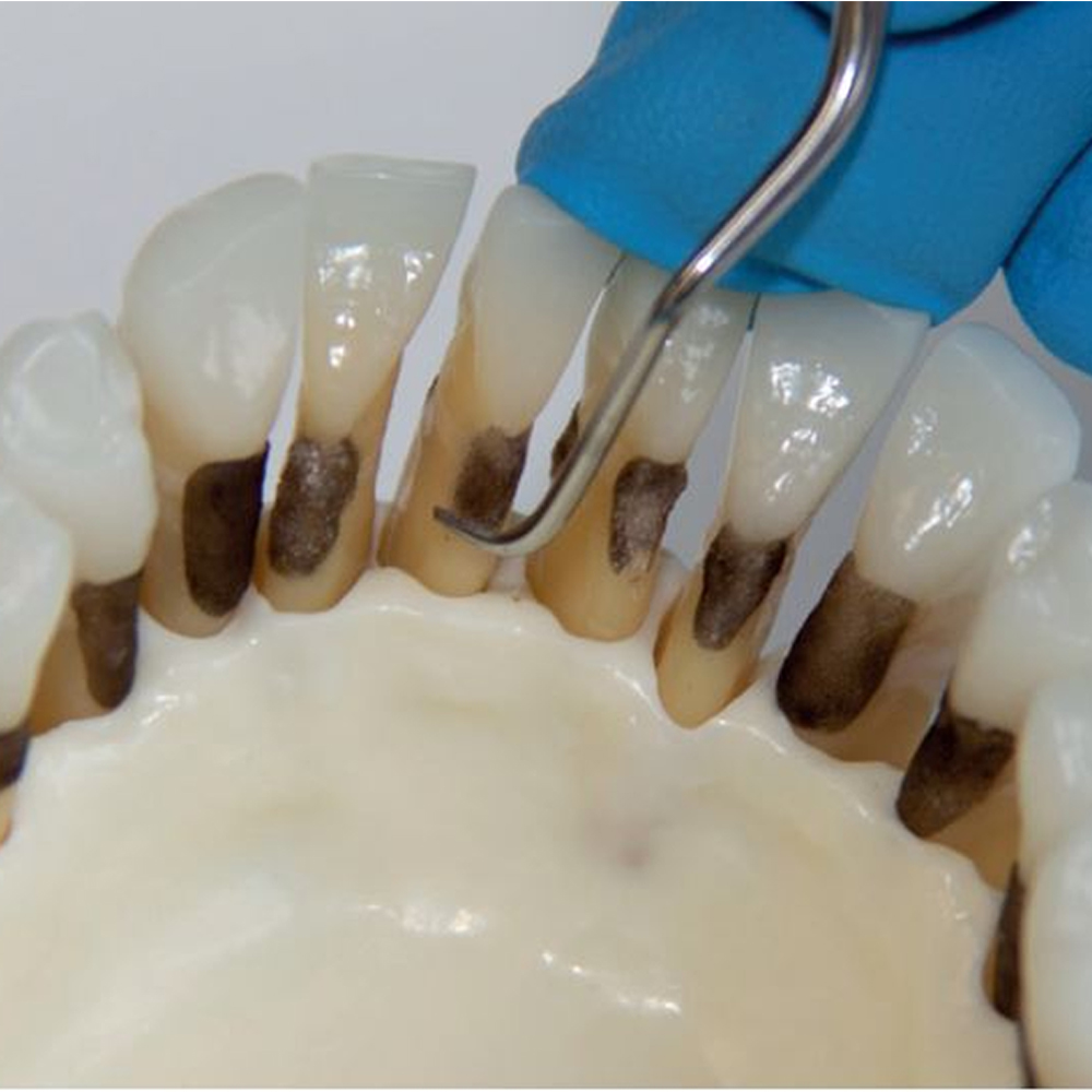 GDC Gracey Curette CC Premolars,Molars,Facial,Lingual Surfaces #7 (Sgcc7/8)