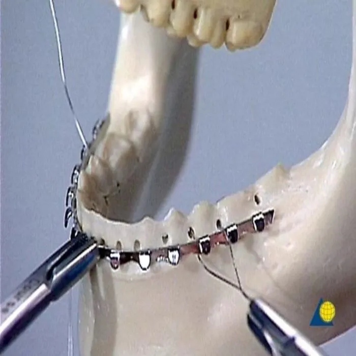 4x Attelles Dentaires Orthodontiques (Arch Splints) - Pour Fracture De La Mâchoire Supérieure - Neuf