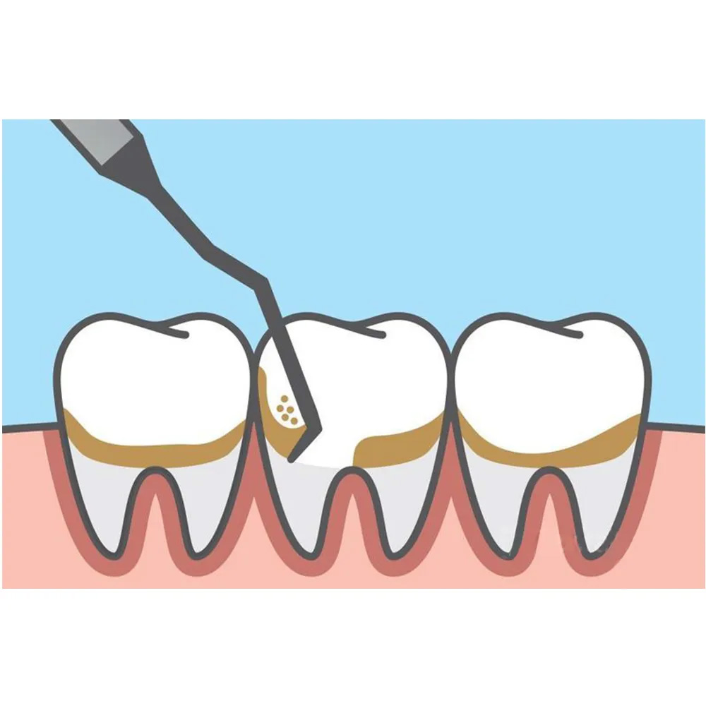 GDC Mccall Curettes #6 (Sm11/12)