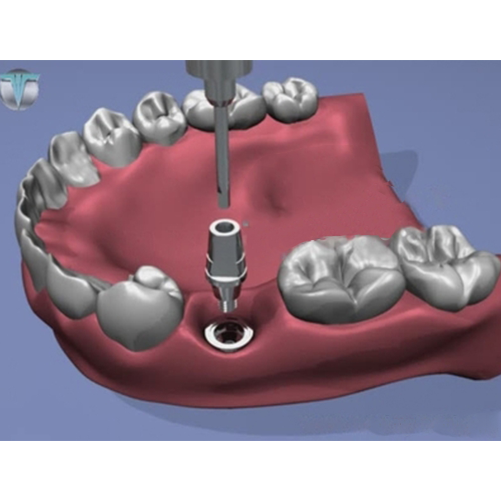 Xcem Dental Implant Submerged Solid Abutment 6mm