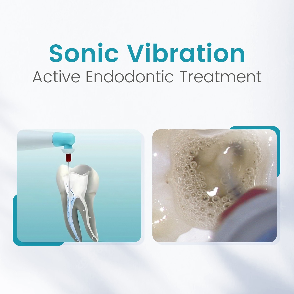 SuperEndo Sonic Flush Endo Irrigator (120 Tips Free)