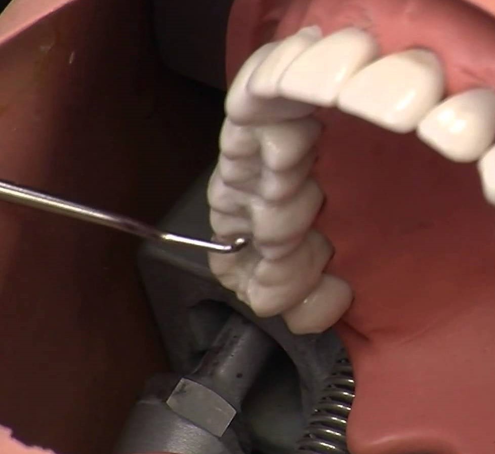 Waldent Spoon Excavators