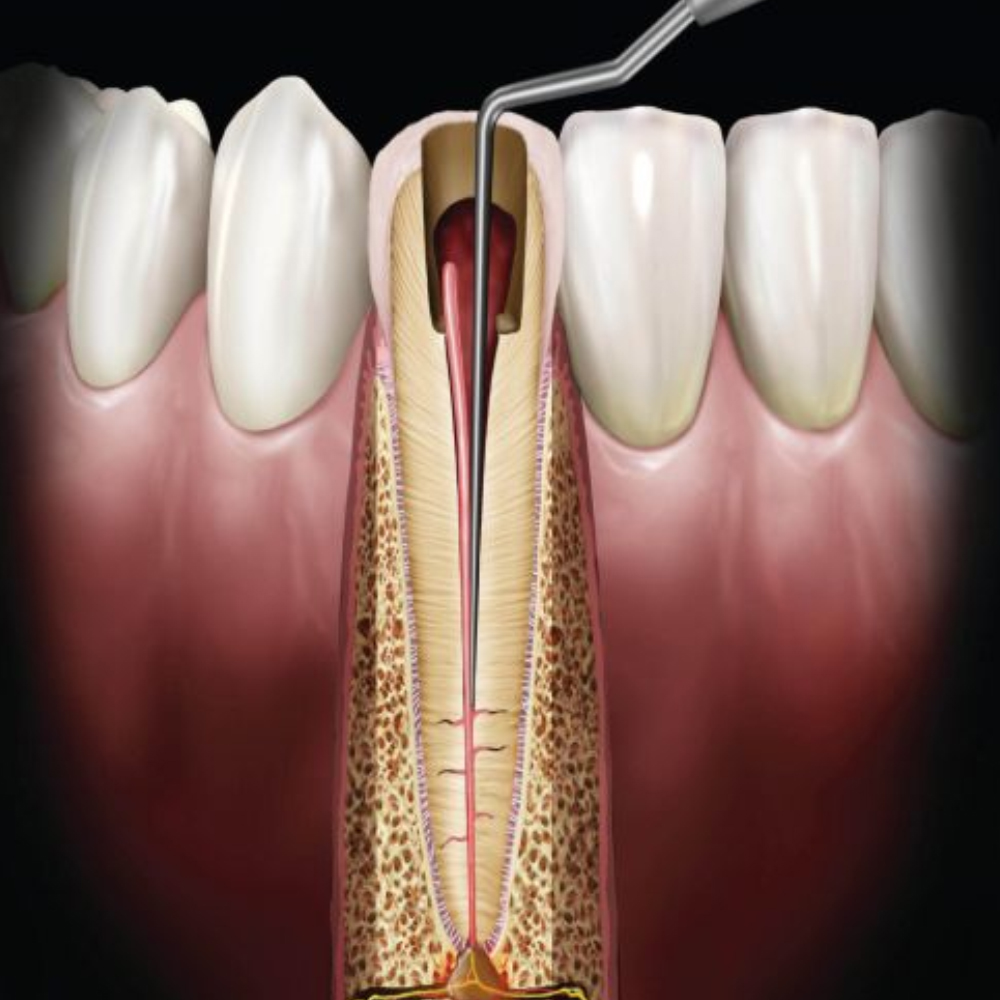 GDC Spreaders -1 (Rcsgp1)