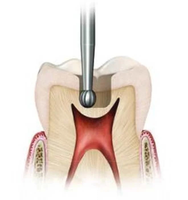 NewDiamond Round Carbide Straight Handpiece Bur-07 (Pack of 5)