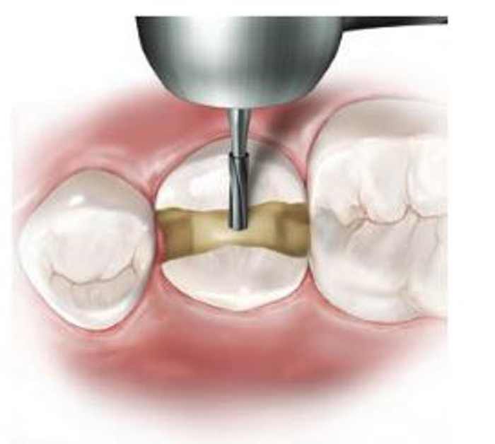 Ss White Surgical Length Carbide Airotor FG Burs