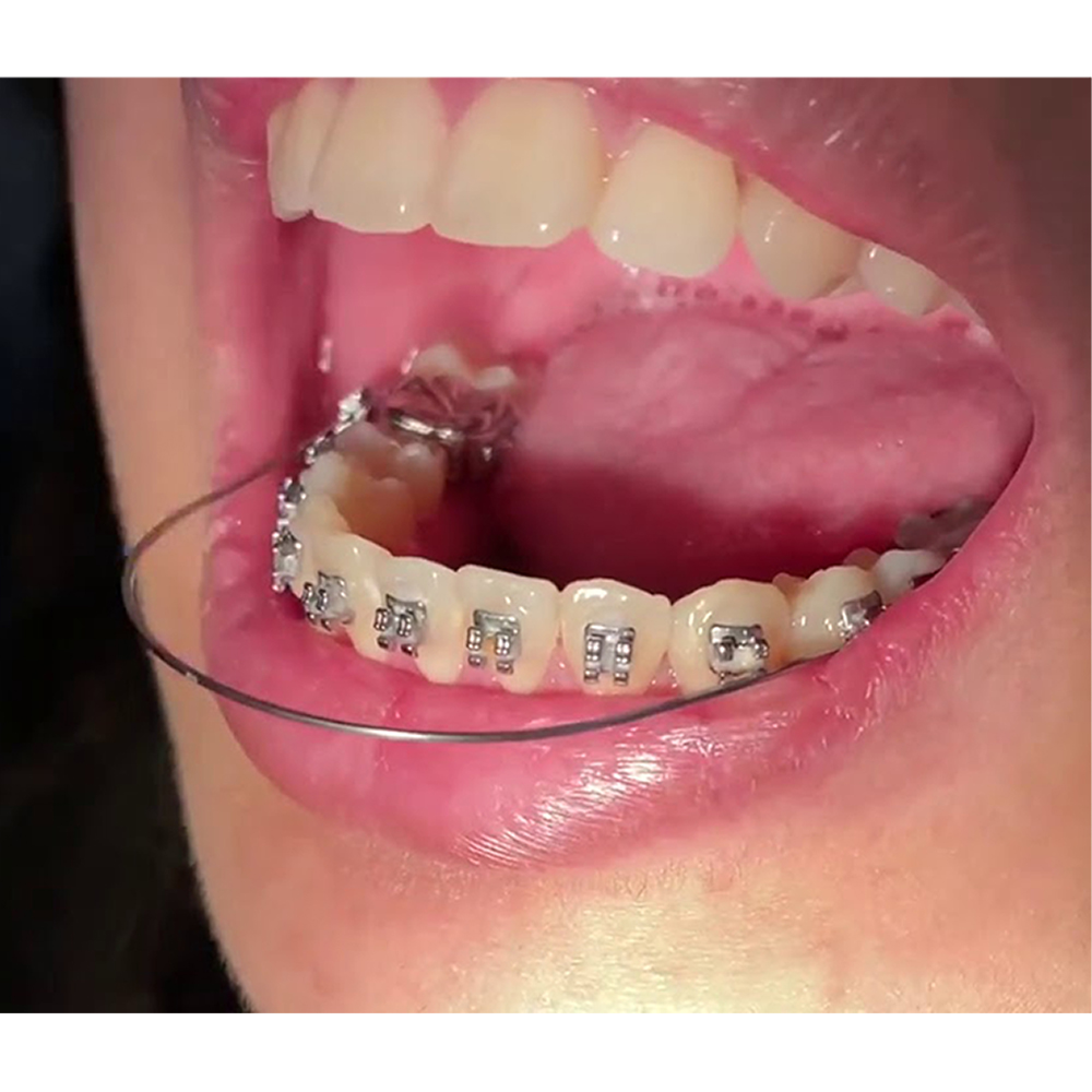 Filo Ortodontico Acciaio In Stanghette - Foto 11