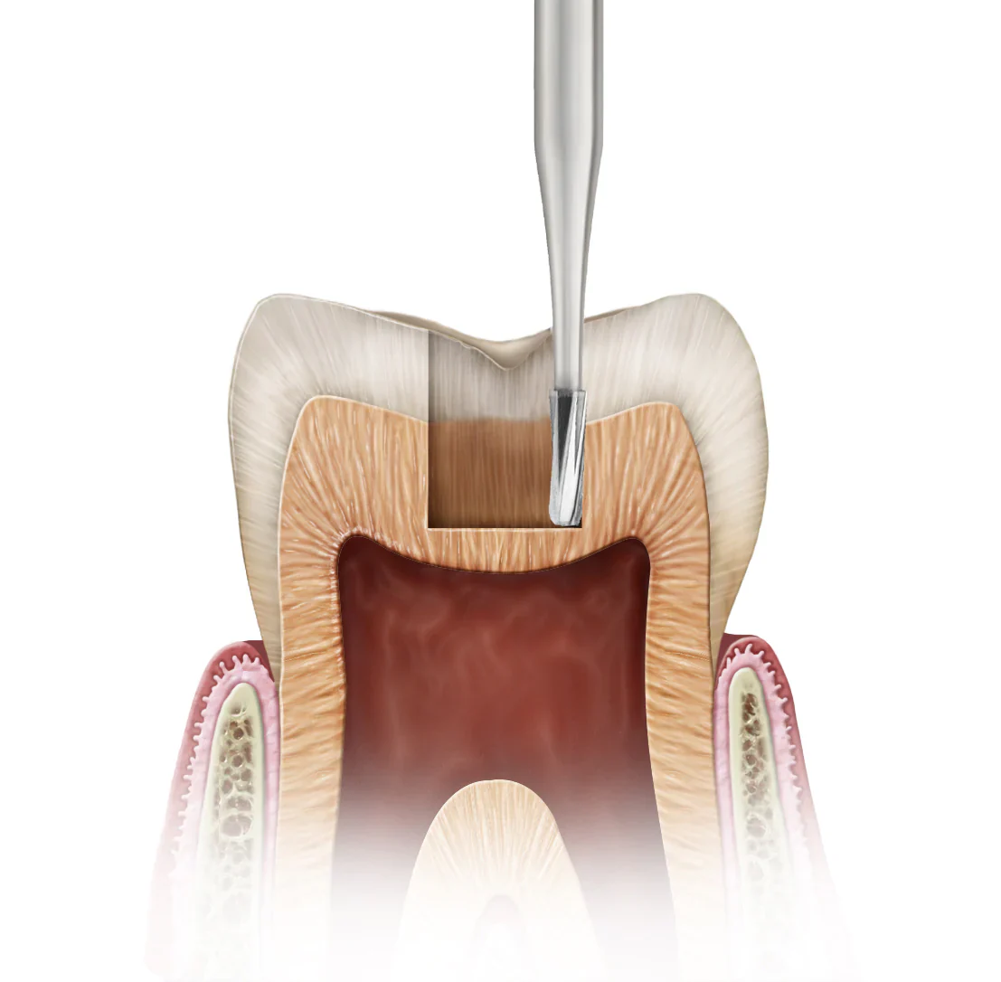 Prima Dental Amalgam Prep Bur (Pack of 10)
