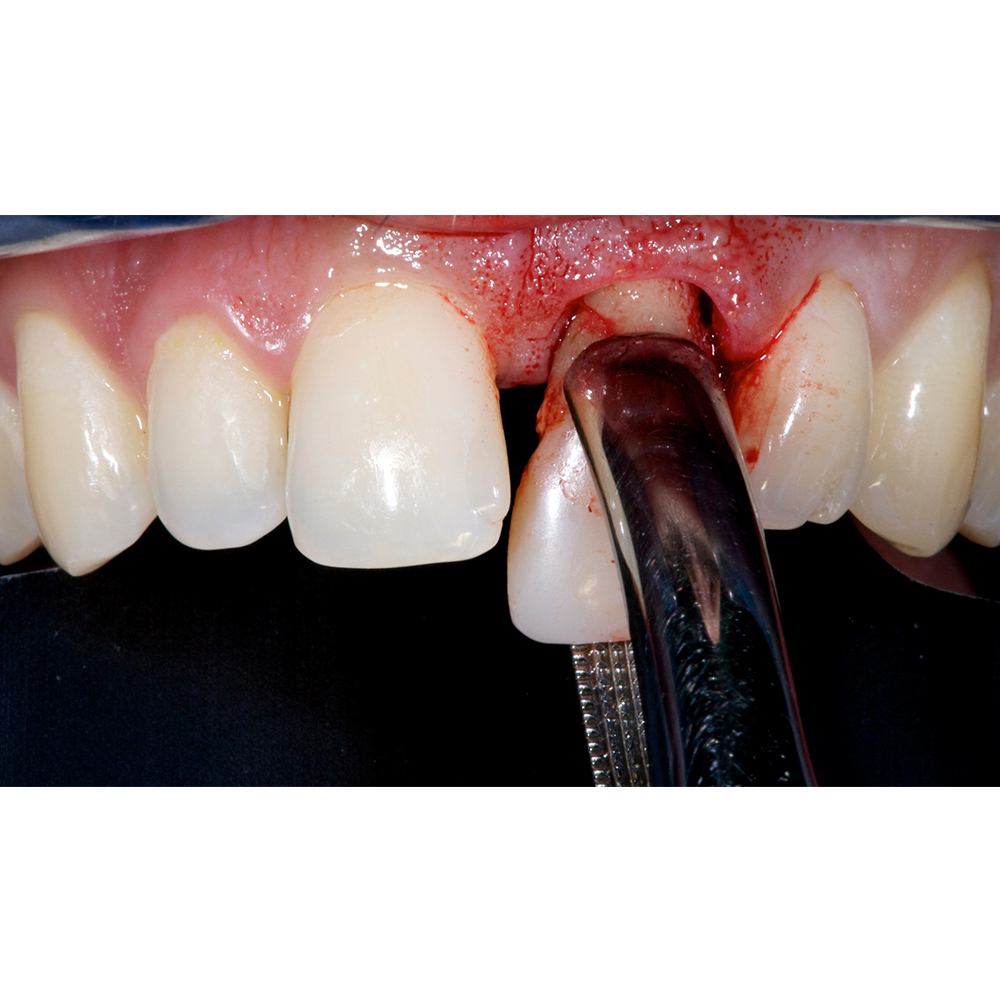 GDC American Extraction Forceps