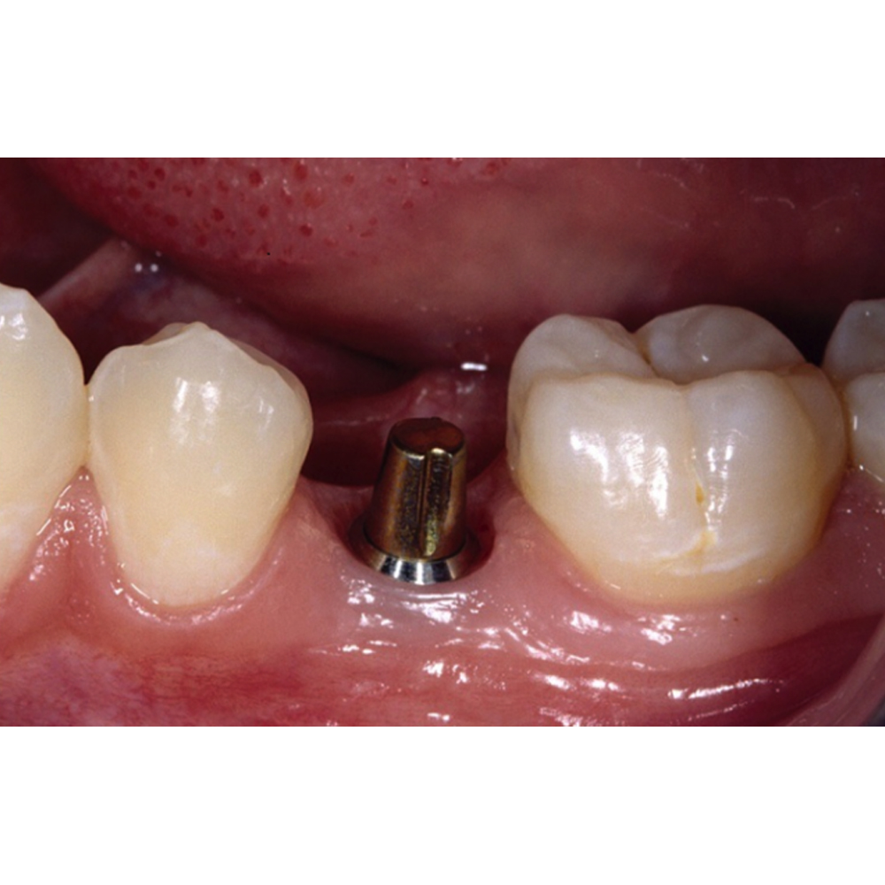 Adin CloseFit NP Straight Abutment