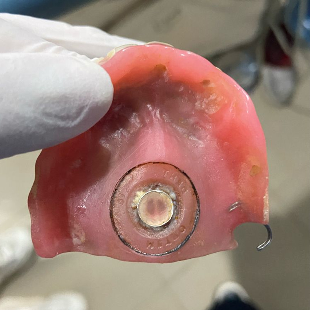 MDM Y - Dents Denture Suction Chamber Discs