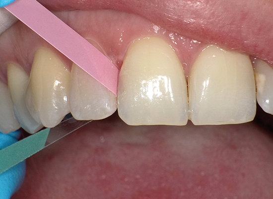 Shofu Super-Snap Polystrips