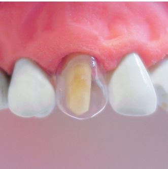 Tor Vm Transparent Crowns 64 pcs - Anterior No. 1.910