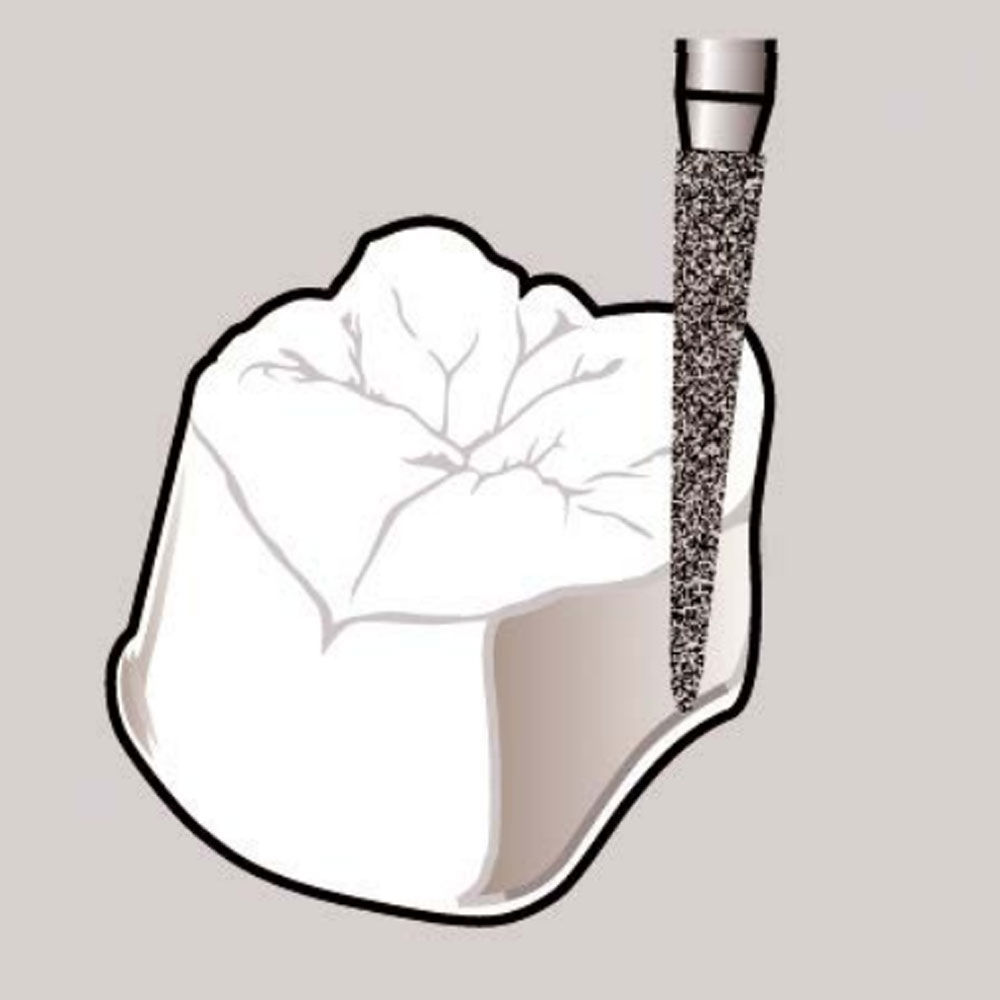 Frank Dental Tapered Cone FG Diamond Burs TC Series (Coarse)