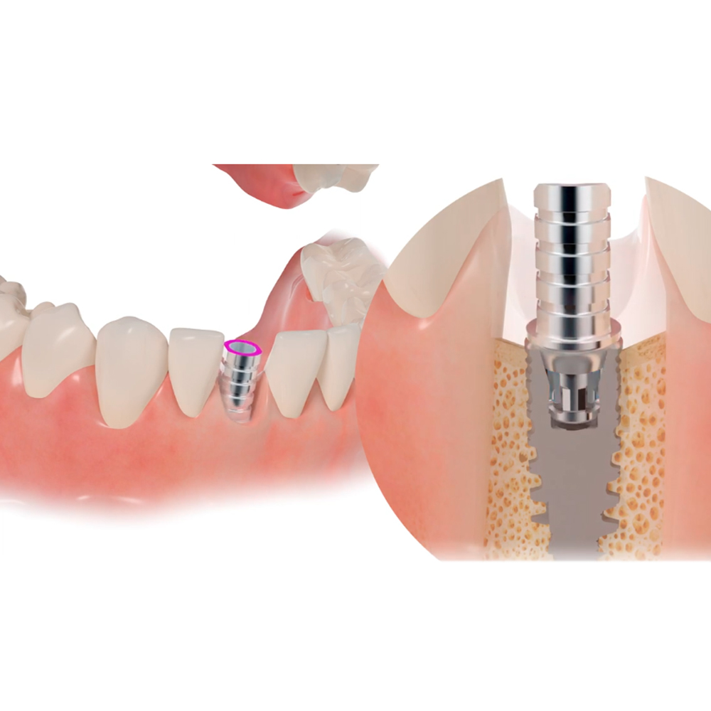 Adin CloseFit NP Temporary Abutments