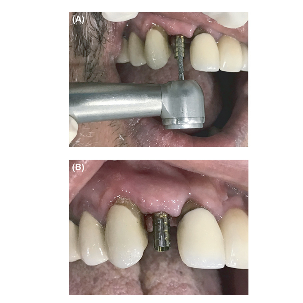 Adin CloseFit NP Temporary Abutments