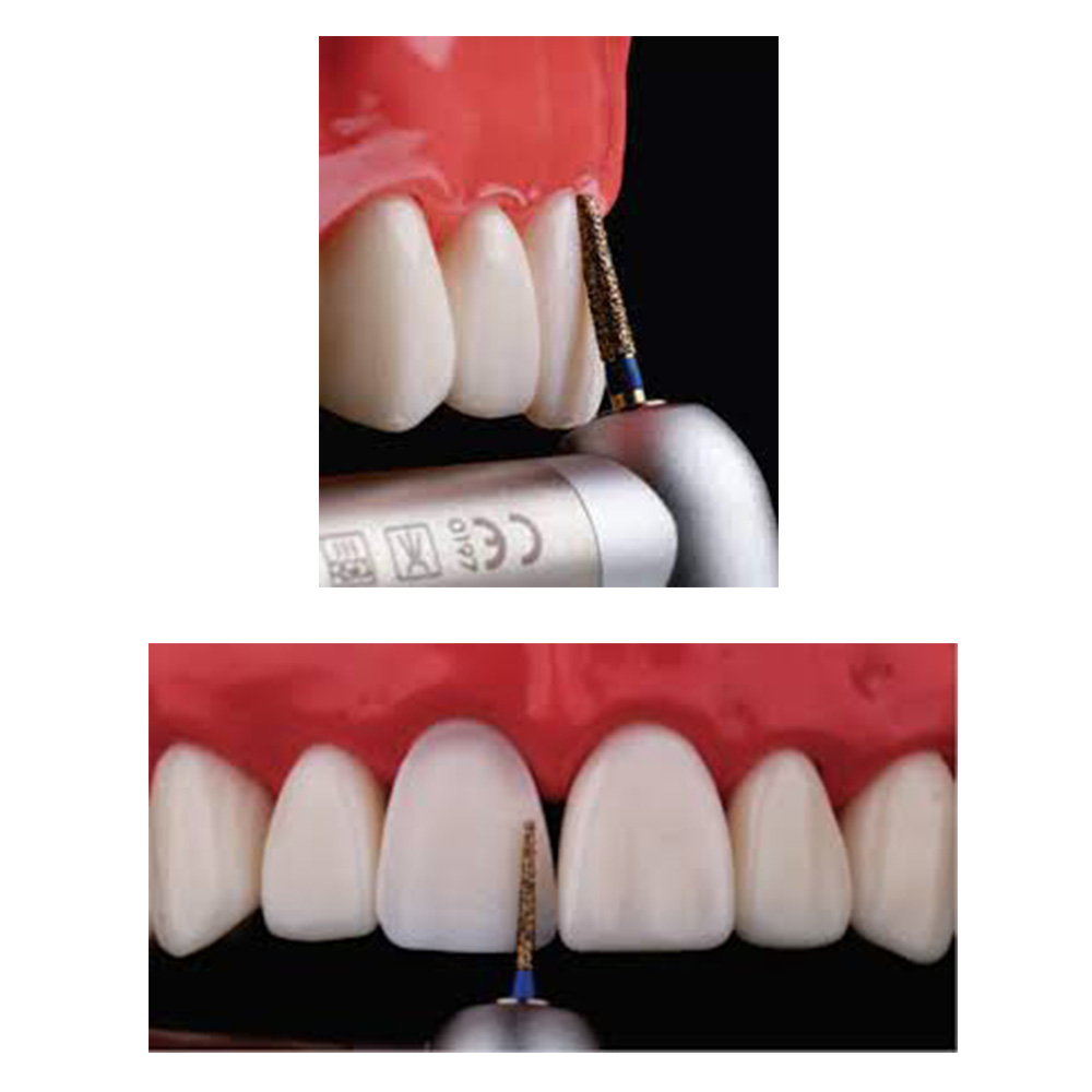 SuperEndo Anterior Preparation Burs Kit  